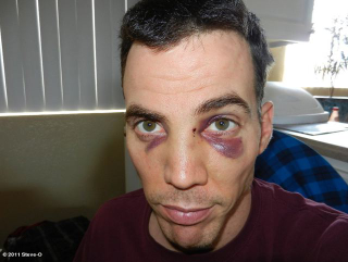 Illustration for article titled Steve-O Gets Two Black Eyes At Charlie Sheen's Roast